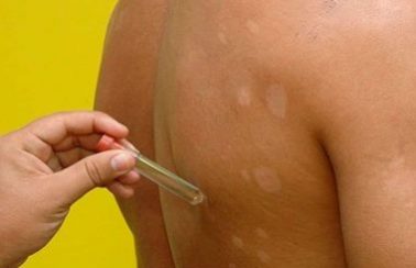 Janeiro Roxo: Salvador registra queda em número de casos de hanseníase