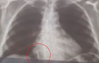 Broca de dentista se solta durante atendimento e vai parar dentro de pulmão de paciente no RN