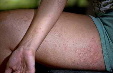 Sociedade Brasileira de Dermatologia investiga surto de lesão misteriosa na pele em Pernambuco