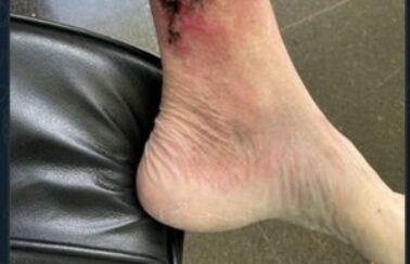 Carlos publica foto de ferida na perna de Bolsonaro e diz que recuperação “corre muito bem”