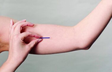 Salvador passa a oferecer Implanon de forma gratuita na rede municipal de saúde